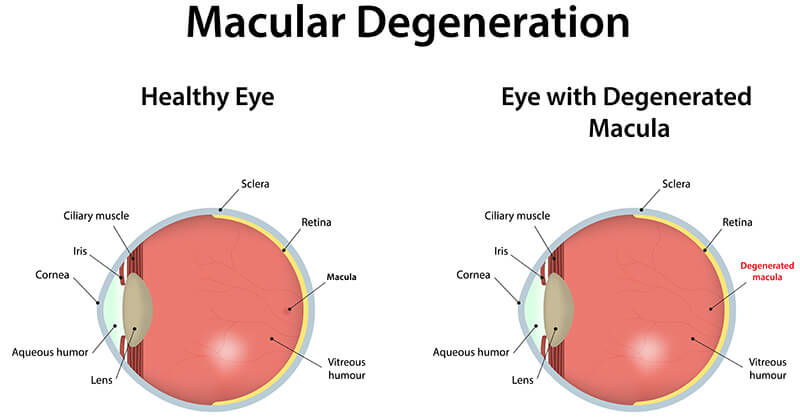 Chart Illustrating a Healthy Eye Compared to One With a Degenerated Macula
