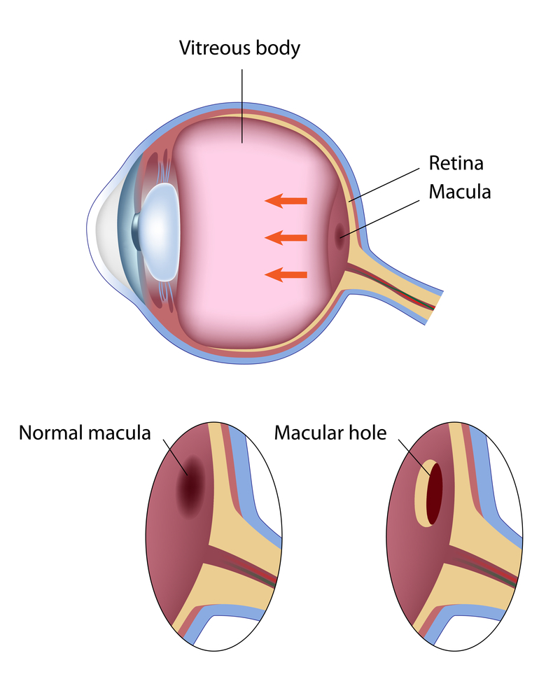 Macular hole diagram